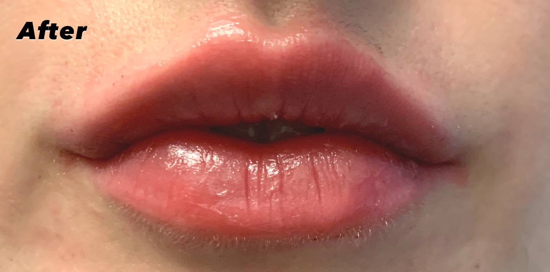 After lip filler treatment