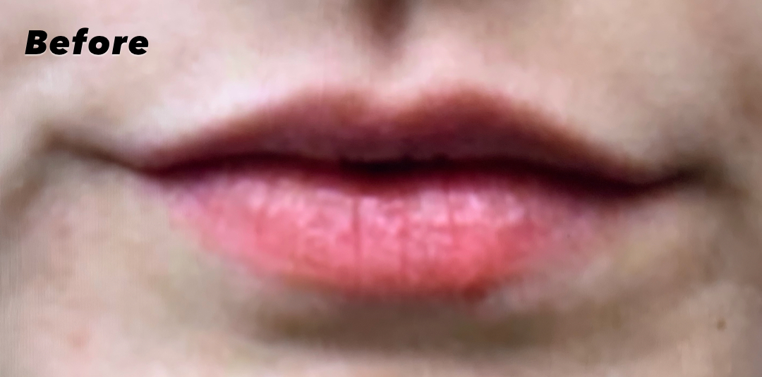 Before lip filler treatment